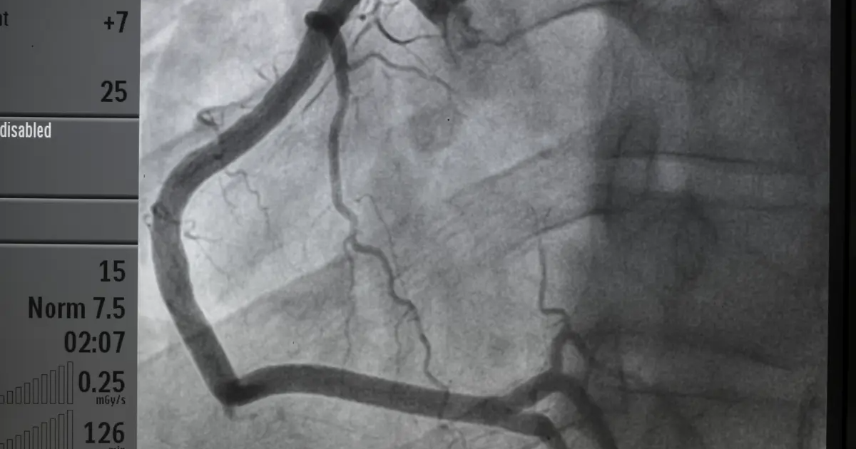 Koronarografia – badanie, które odkrywa tajemnice serca
